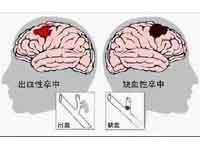 出血性脑卒中