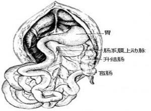 先天性肠旋转异常