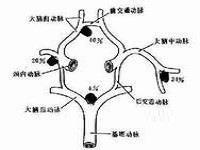 椎-基底动脉盗血综合征