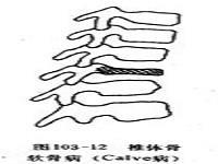 椎体骨软骨病