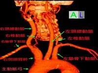 颈动脉盗血综合征