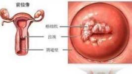 宫颈癌前病变