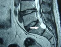 骶管囊肿
