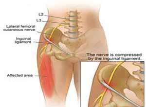 股外侧皮神经病