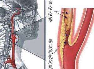 动脉粥样硬化