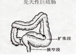 先天性巨结肠