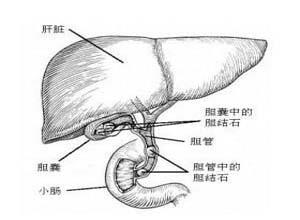 小儿急性胆囊炎