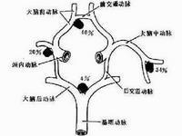 脑动脉盗血综合征