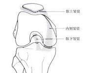 膝关节滑膜皱襞综合征