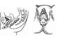阴道脱垂