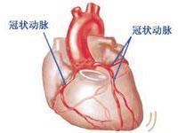 隐匿型冠状动脉粥样硬化性心脏病