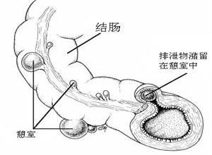 消化道憩室病