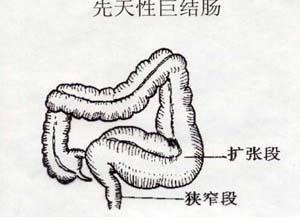 小儿先天性巨结肠