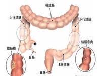 盲肠阿米巴肉芽肿