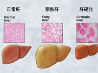 自身免疫性肝硬化