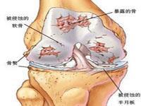 髋关节滑囊炎