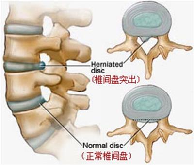 久坐不动当心腰椎间盘突出成新宠