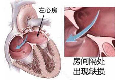 房间隔缺损(房缺)