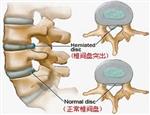 腰椎间盘突出不是病 是你的气血亏了