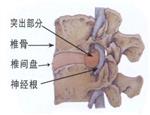 贴膏药不能治好腰椎间盘突出