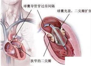 二尖瓣狭窄患者的自我保健